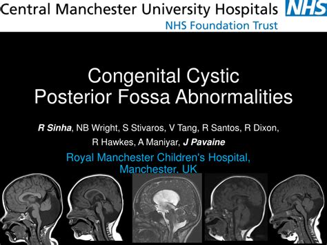 mega cisterna magna prognosis|Anomalies of the posterior fossa .
